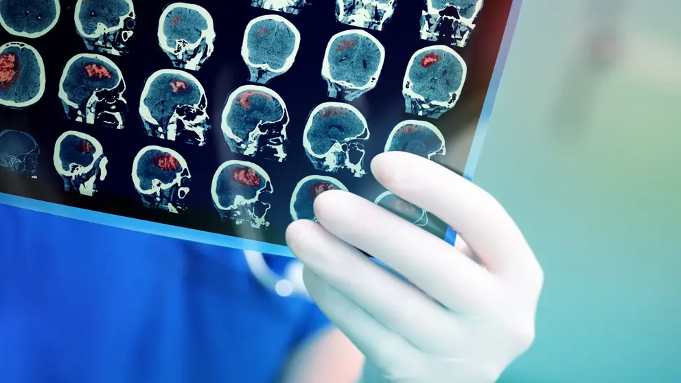 Closeup of doctors hand holding CT brainscan