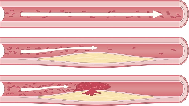 how does a fatty streak happen in arteries