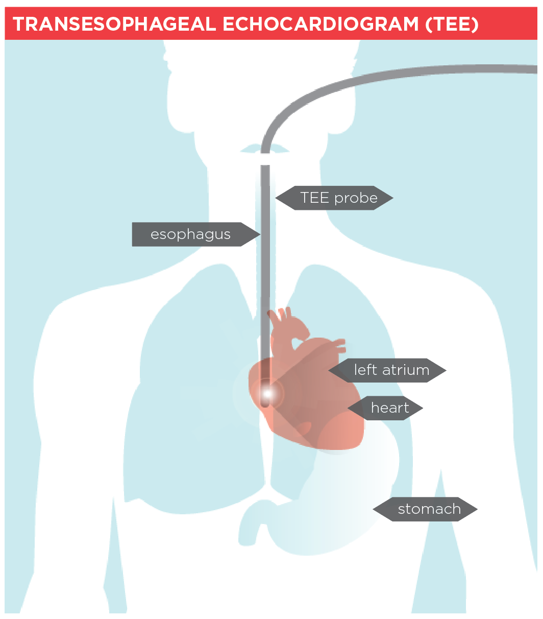 Transesophageal Echocardiogram (TEE) | Heart and Stroke Foundation