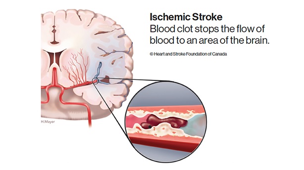 Left-side Stroke: What is Damaged, Effects and Treatment