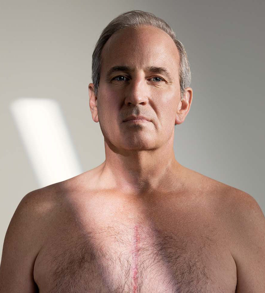 Paul King, showing his incision scar from his heart surgery. 